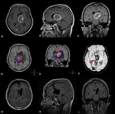 Risk Factors for Early Hydrocephalus on Post Unilateral Thalamic Tumor Resection